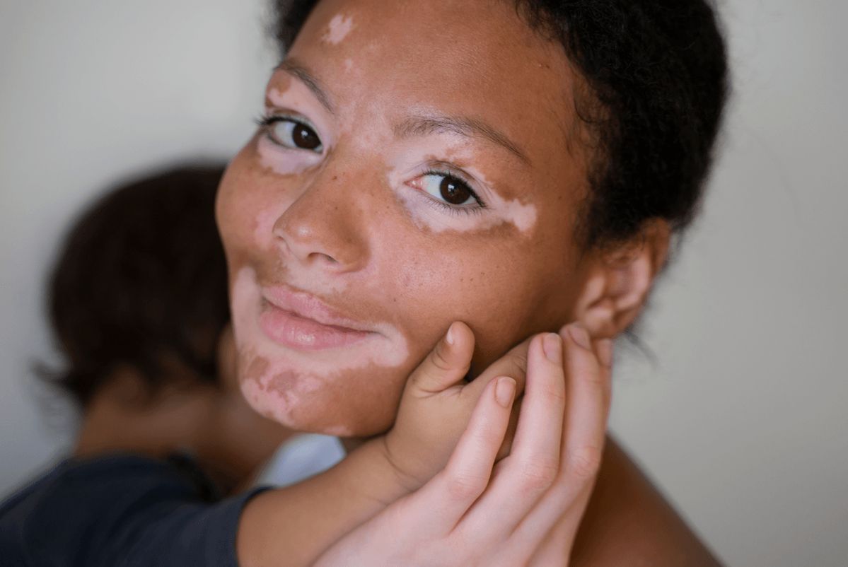 Vitiligo Care Centre patient care
